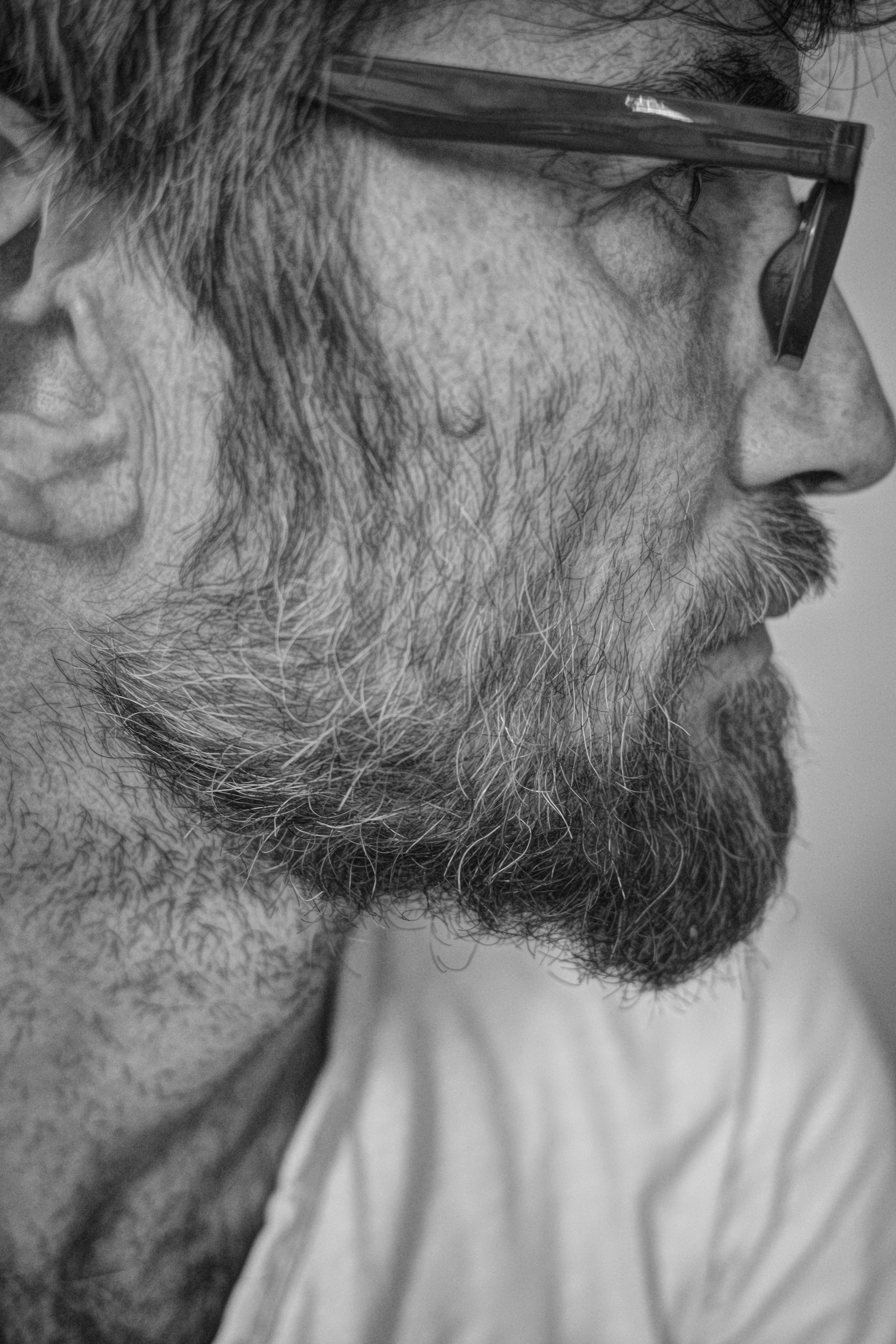 Depilação a laser masculina — Barba Completa